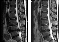 추간판탈출증 수술 전/후 X-ray 